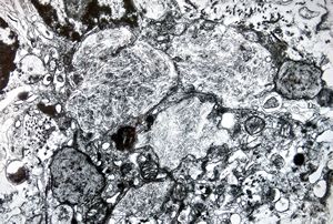 Whipple disease Whipple disease